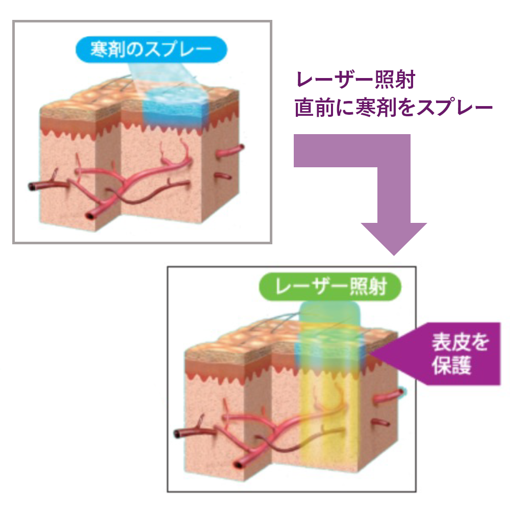 スポットサイズは3㎜から最大15㎜