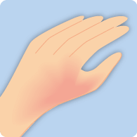 苺状血管腫（赤あざ）